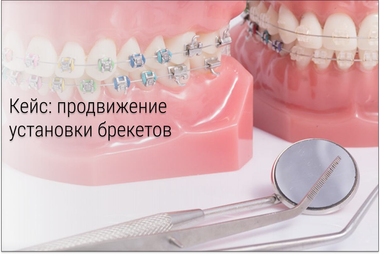 Кейс: пациенты на установку брекетов по 1.340₽ с рекламы ВК