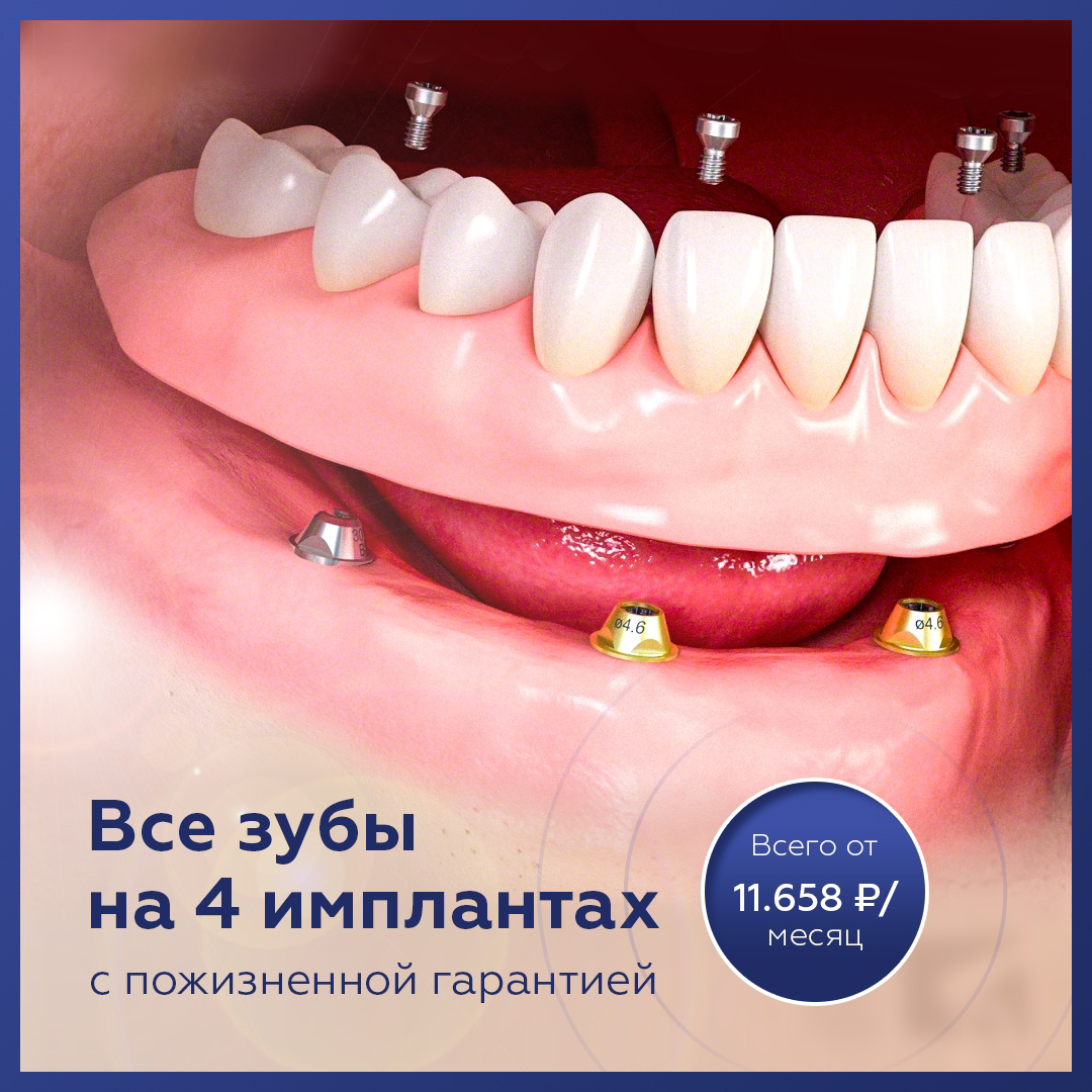 Кейс: пациенты в стоматологию по 657 рублей (имплантация)